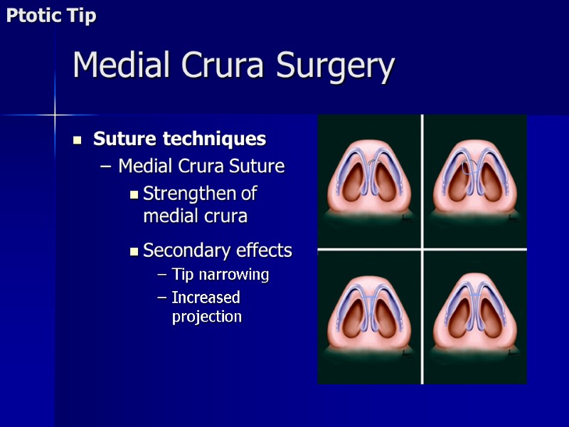 >Medial Crura Surgery Suture techniques Medial Crura Suture Strengthen of medial crura  Secondary